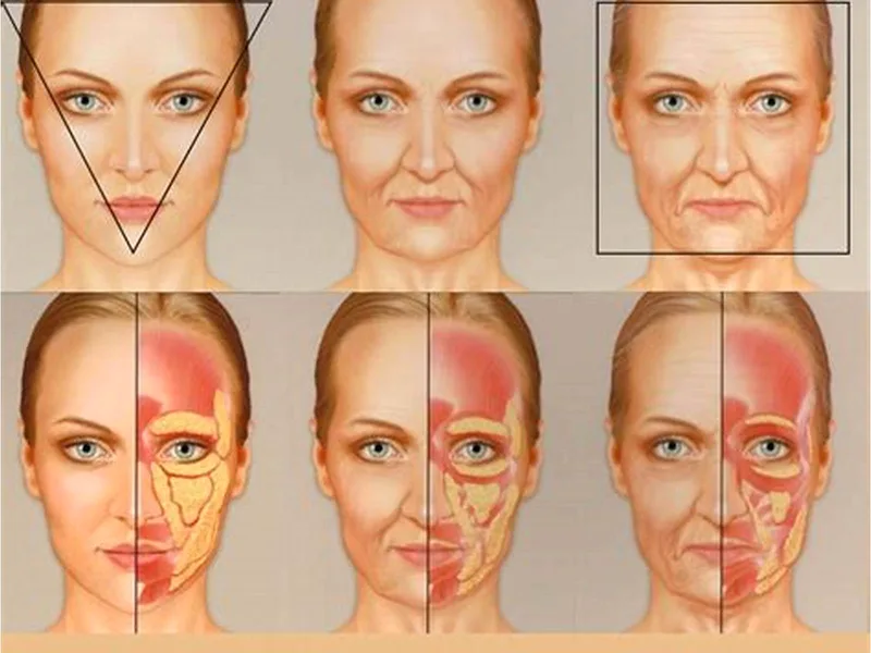 'Rosto de Ozempic' — perda de gordura facial após emagrecimento